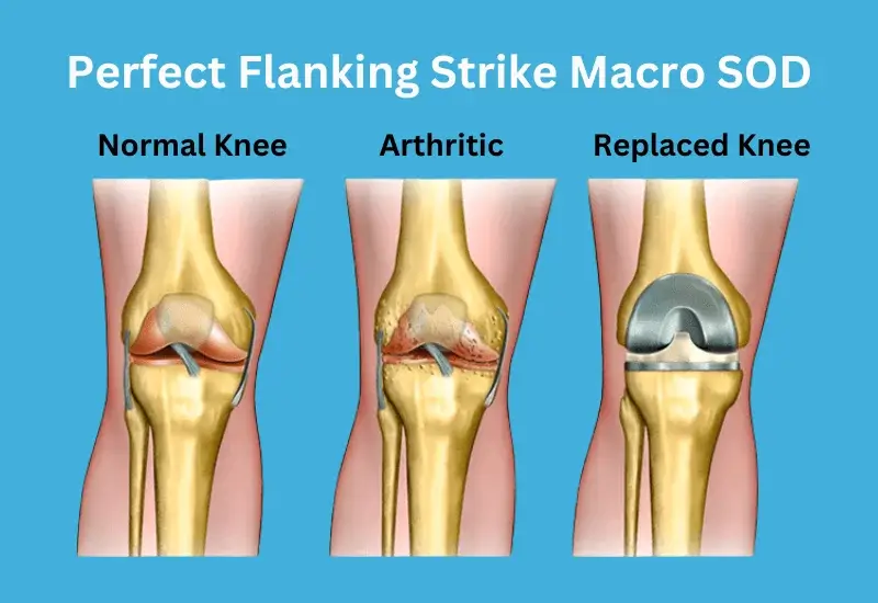 Knee Replacement